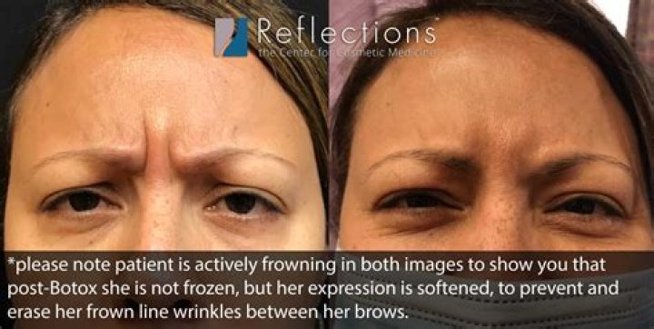 Botox Between Eyebrows - How To Discuss