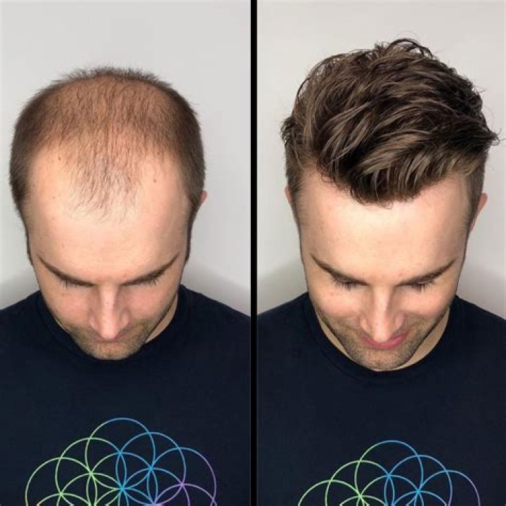 Hair Replacement System - How To Discuss
