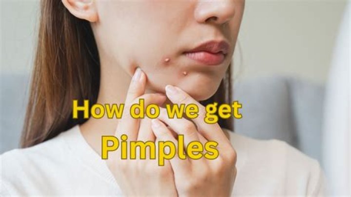 How do pimples form - How To Discuss