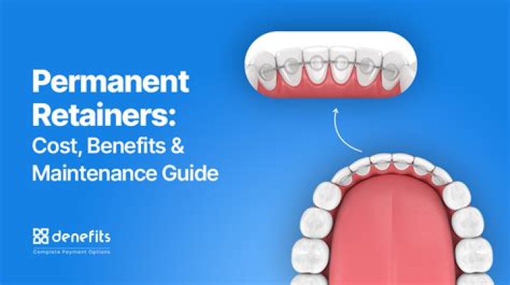 Permanent Retainer Cost - How To Discuss