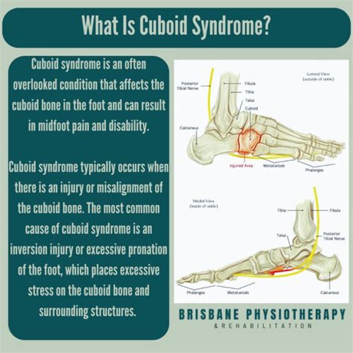 Quick Answer: How To Self Adjust Cuboid Bone
