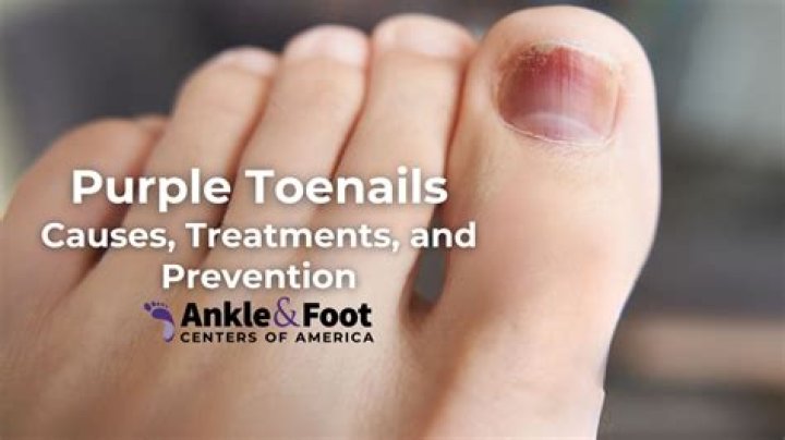 Toenails Turning Yellow - How To Discuss