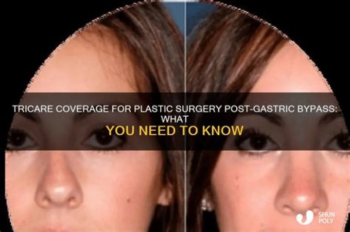 Will Tricare Cover Gastric Sleeve